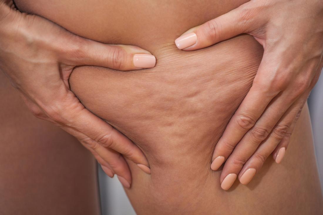 Image result for Cellulite