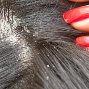 Head Lice Treatment - The Difference Between Nits and Dandruff 1