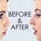 Rhinoplasty - Nose Reshaping - Enhance the Beauty of Your Nose 8