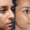 5 Important Facts About Open Rhinoplasty 12