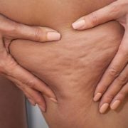 Cellulite: The Myths And The Facts 2